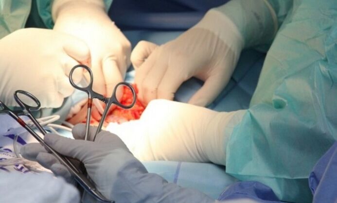 Ligamentotomie-Operation zur Penisvergrößerung. 