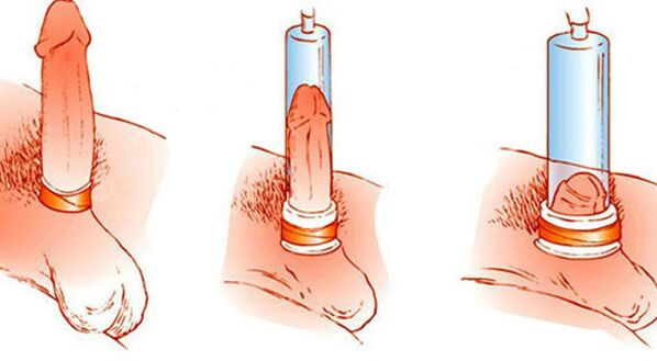 Das Funktionsprinzip einer Vakuumpumpe, die den Penis vergrößern kann. 